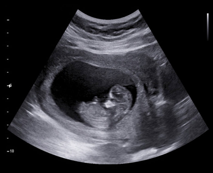 Ultrasound Studies